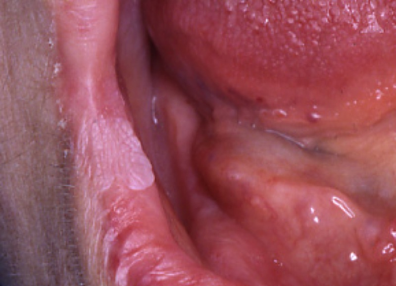 hpv labbro inferiore